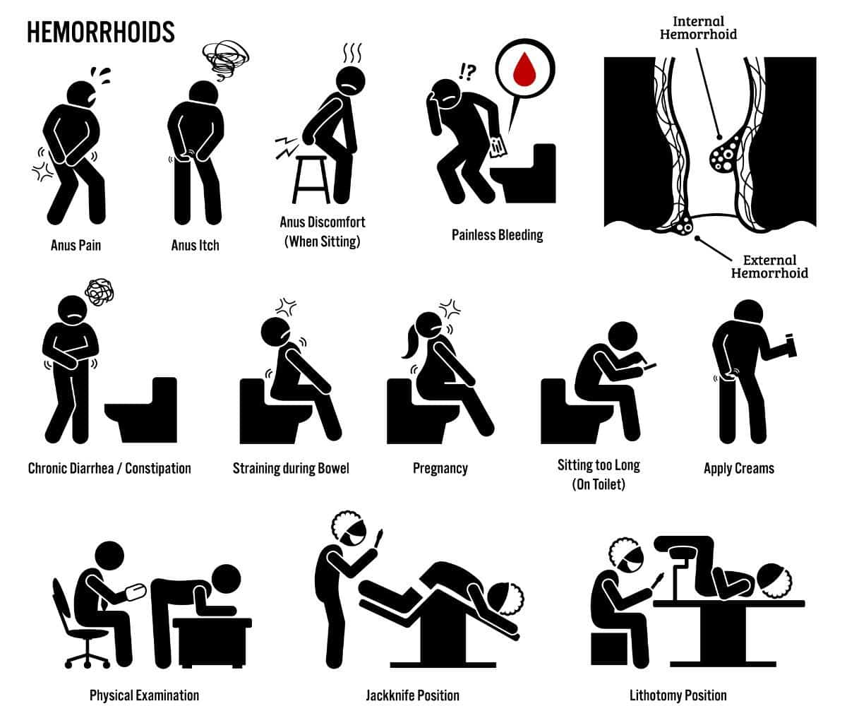 meaning of hemorrhoids