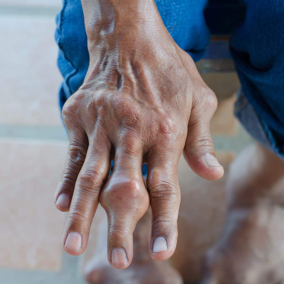 Spiritual Meaning of Gout