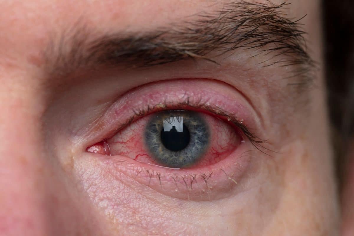 is a popped blood vessel in eye bad