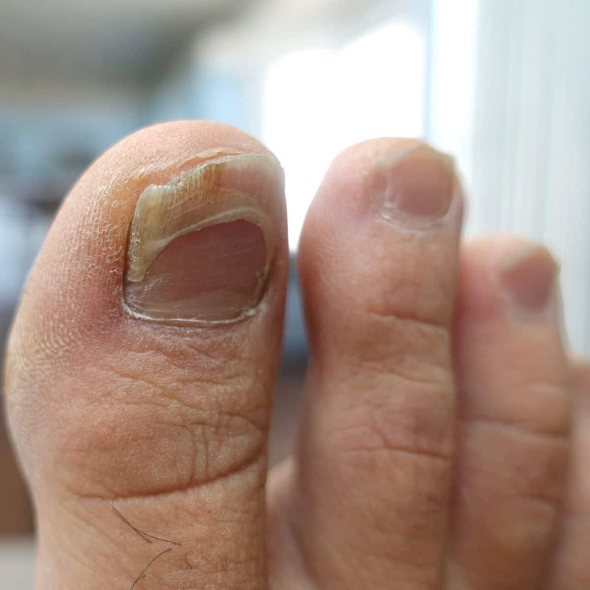 spiritual meaning of losing a toenail