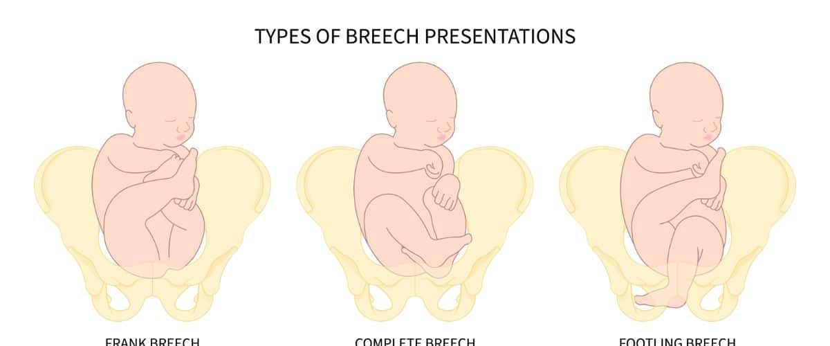 What Are the Risks of a Baby Being Born Breech
