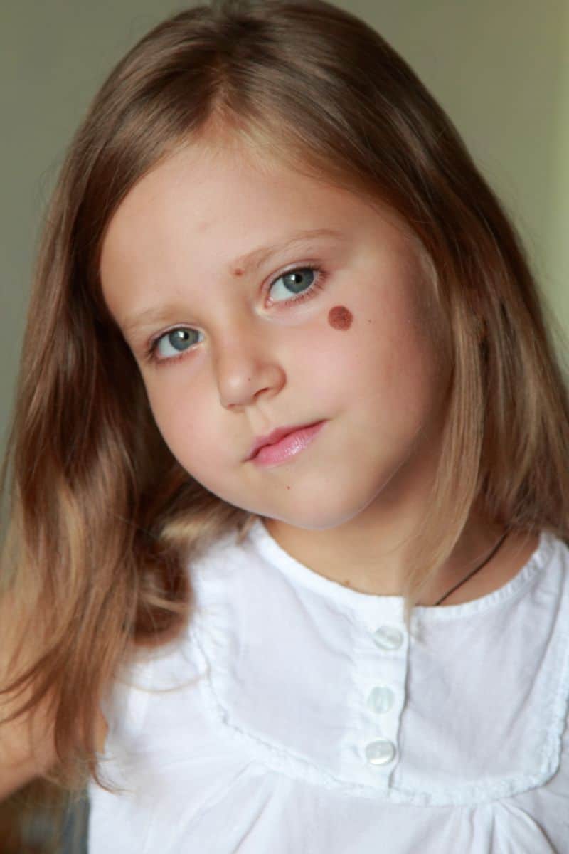 Do Birthmarks Have Meaning in The Bible