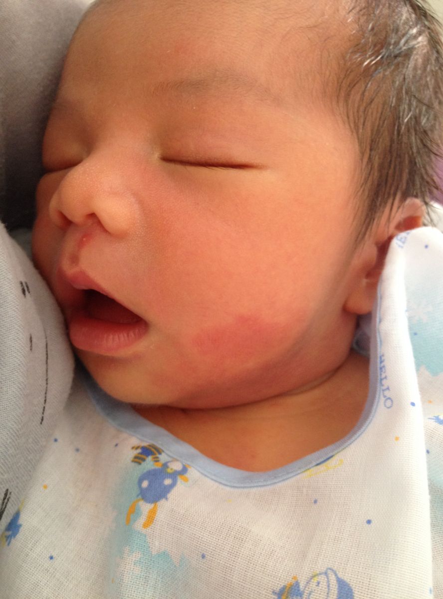 Do birthmarks have a spiritual meaning